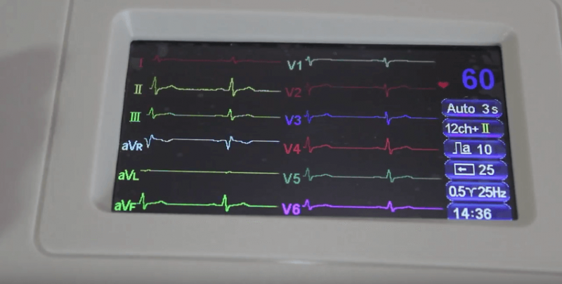 ekg1-5