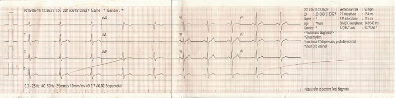 hasil print ekg terinterprestasi